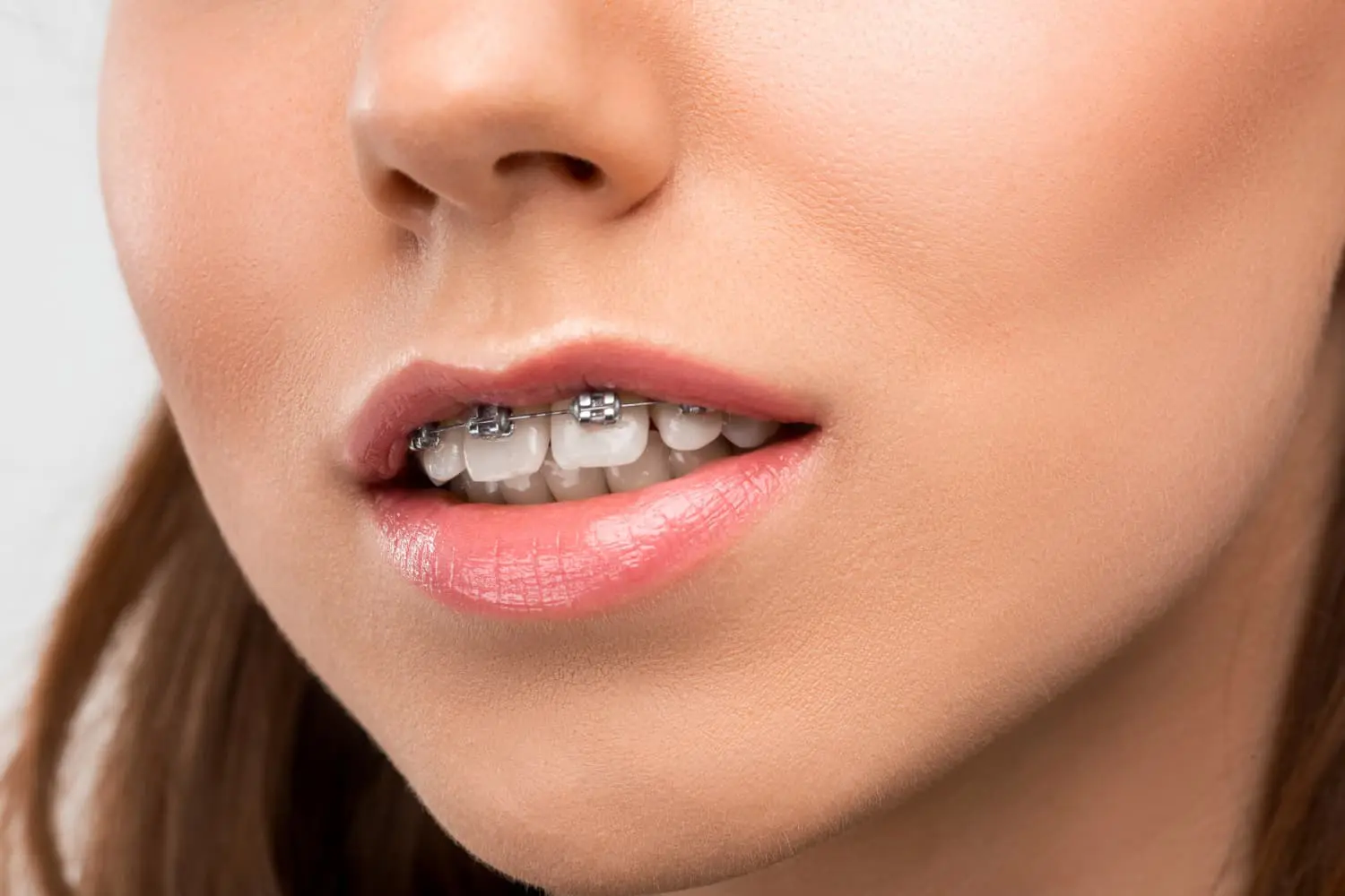Young woman receiving expert orthodontic care for her overbite