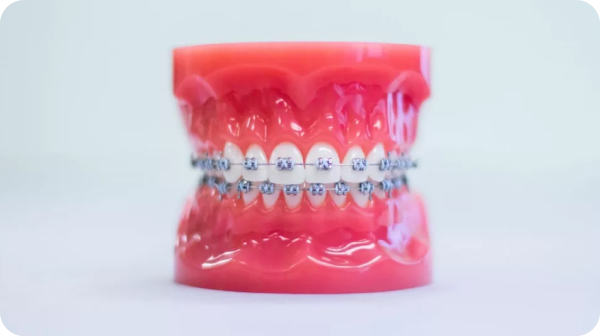 Metal braces straightening teeth effectively during an orthodontic treatment journey.