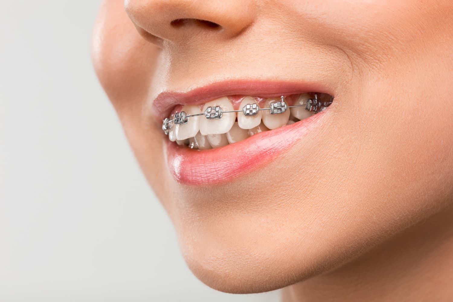 Woman smiling confidently while undergoing treatment for overbite at a trusted orthodontic clinic