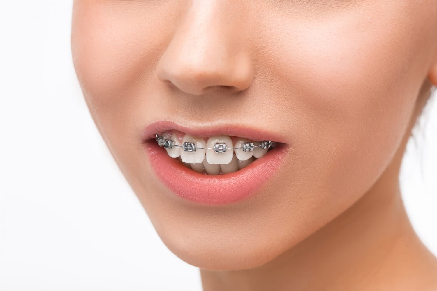 Progress photo of a woman undergoing orthodontic treatment for overbite correction