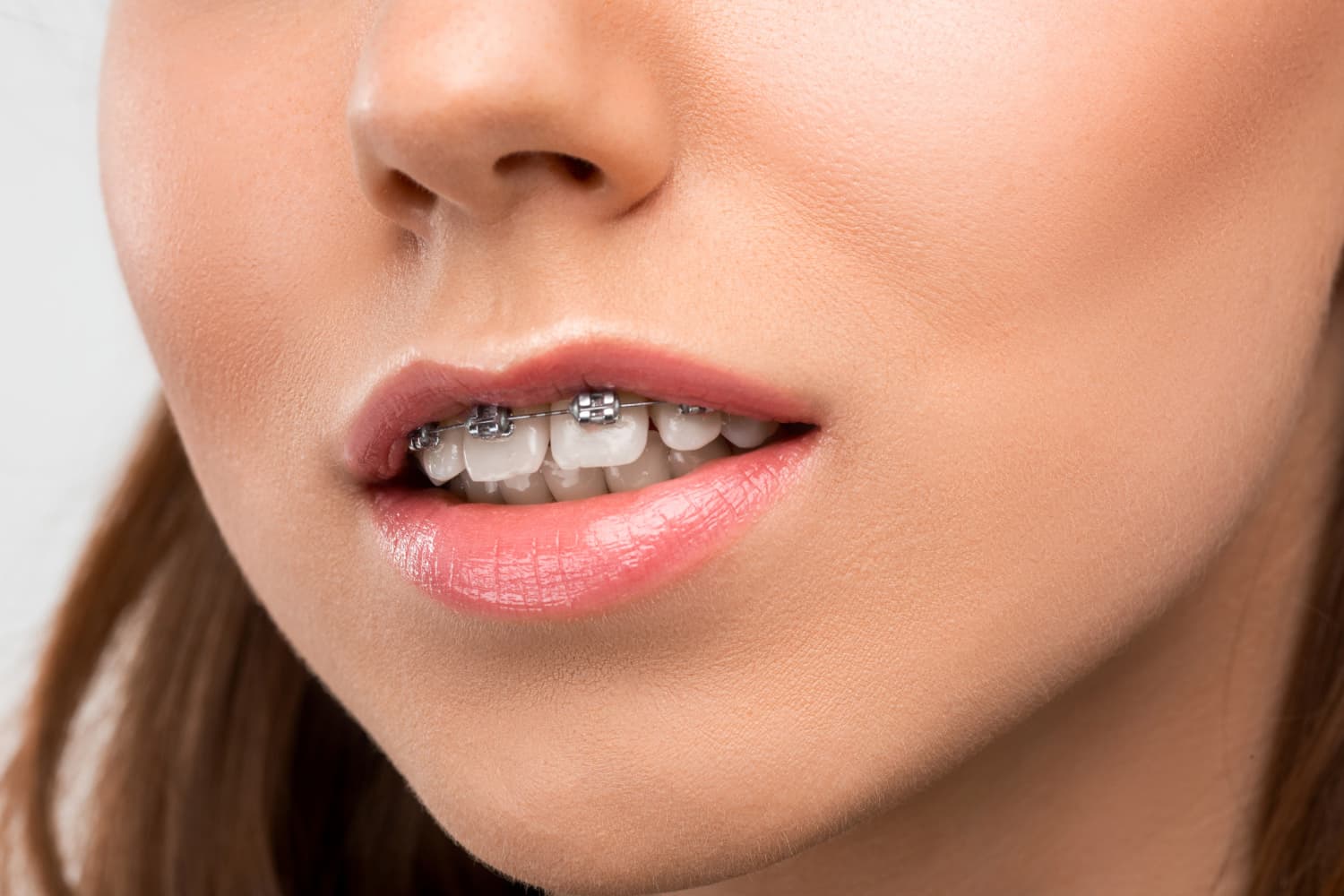 Young woman receiving expert orthodontic care for her overbite