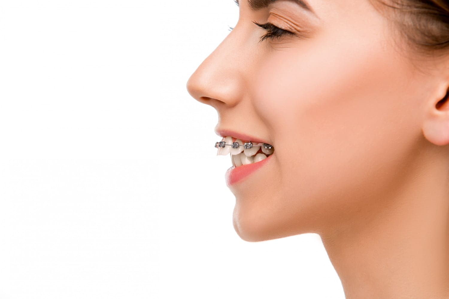 Side profile of a woman with an overbite receiving orthodontic treatment