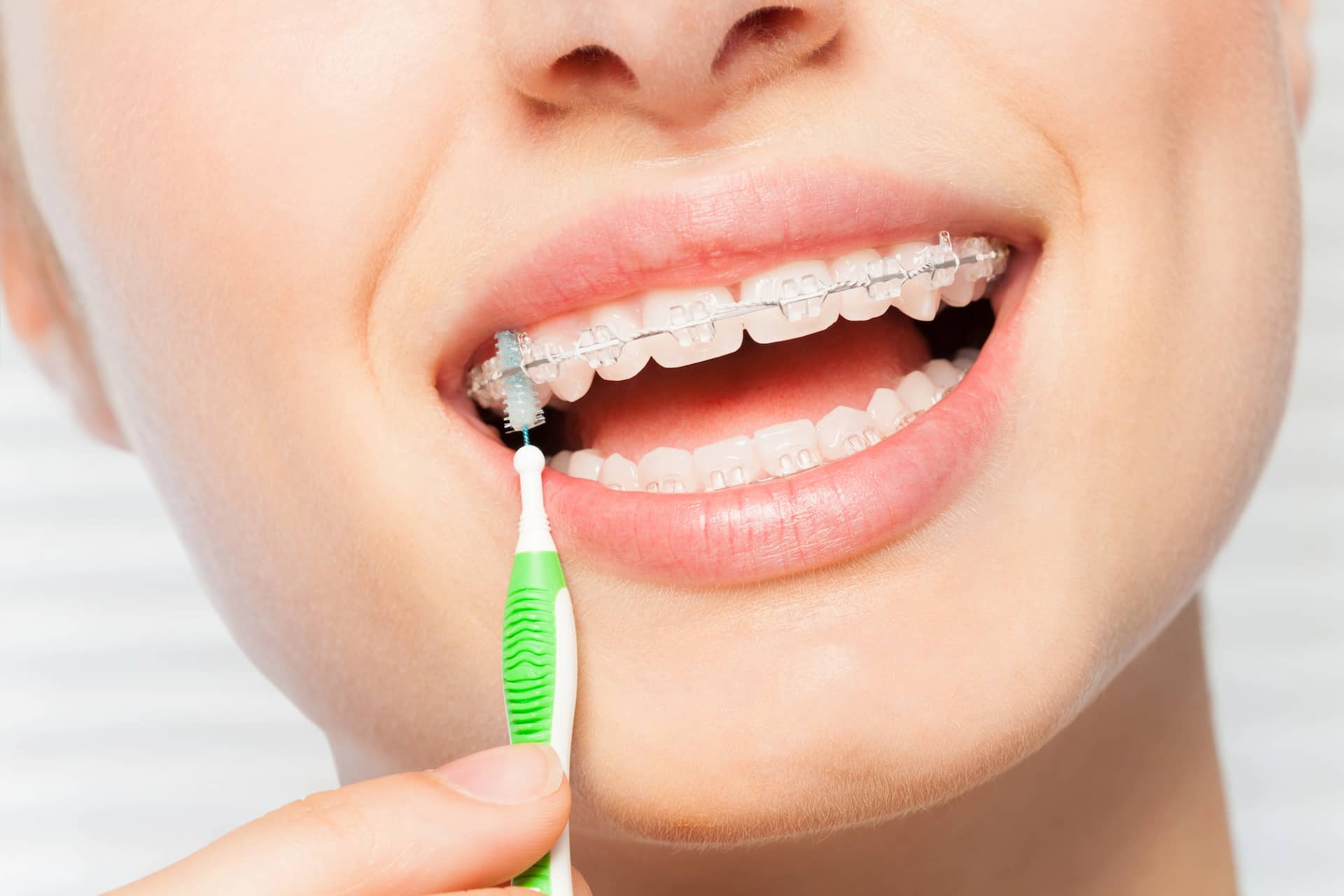 Person cleaning braces with a green interdental brush, focusing on the teeth.