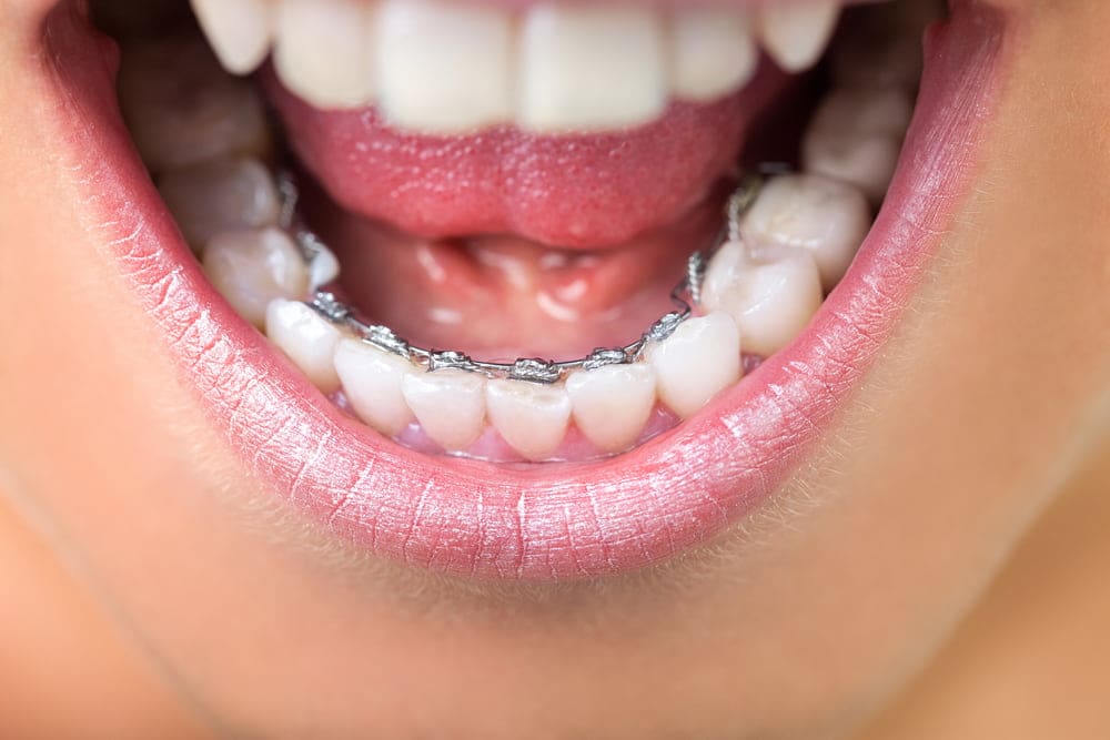 Close-up of lingual braces placed on the back of a patient’s teeth for an invisible orthodontic solution