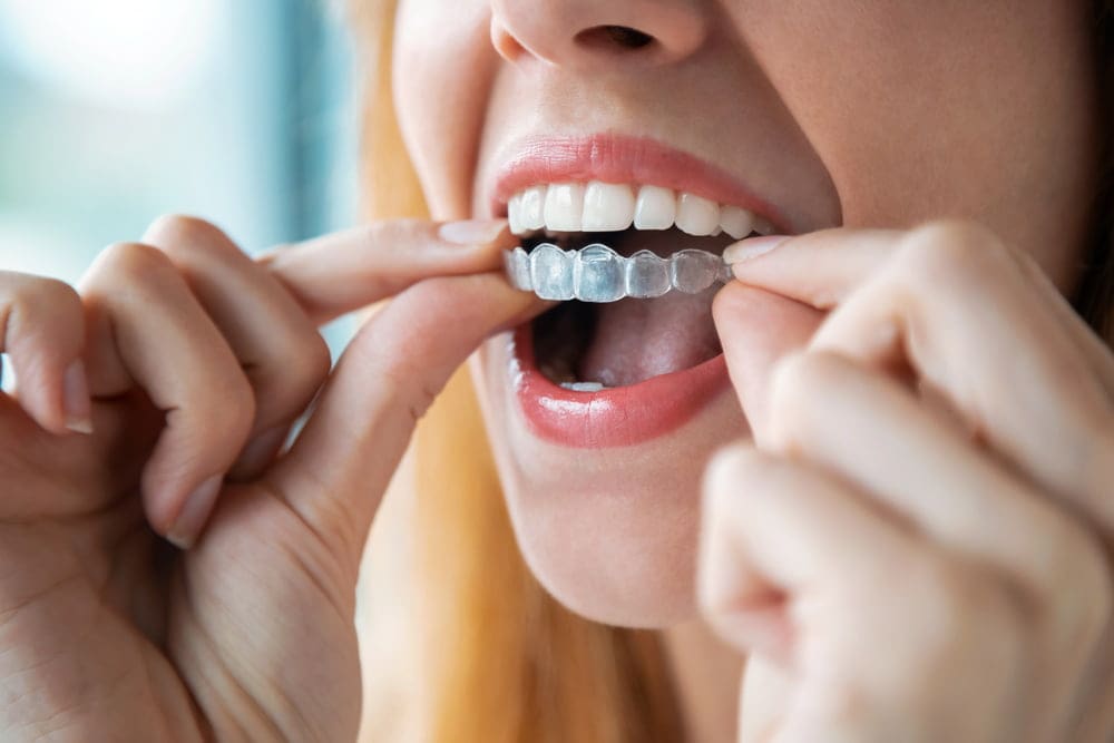 A person inserting a clear dental aligner onto their upper teeth using their hands.