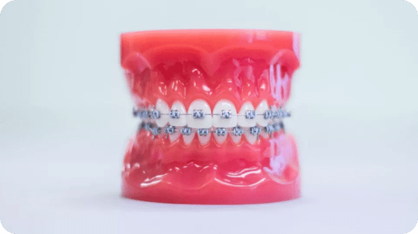 Metal braces straightening teeth effectively during an orthodontic treatment journey.