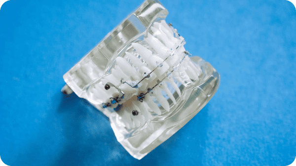 Component of metal braces at Best Orthodontics