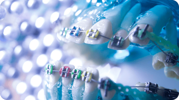 Colorful world of elastic ties of metal braces at Best Orthodontics
