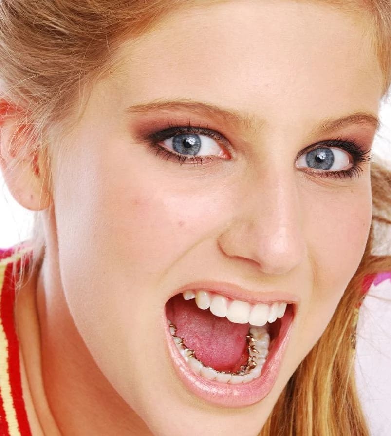 Close-up of a person with blue eyes and an open mouth, revealing metal braces from Best Orthodontics on their teeth. They have light hair and are wearing makeup.
